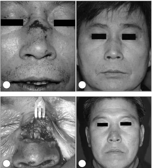 Fig. 3. A case of 42 years old man. One  stage operation (immediate wound  re-pair and open reduction)