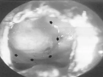 Fig. 1. A preoperative coronal view of orbit CT scan shows an expansile soft tissue mass in the right maxillary sinus, extending  into the ipsilateral orbit and abutting the inferior rectus muscle