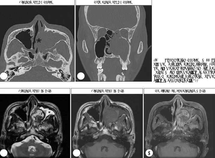 Fig. 2. Preoperative MRI scan in 55 yr-old man with left nasal obstruction. A：T2-weighted image shows relatively well defined round  mass demonstrating heterogeneous high and low signal intensity