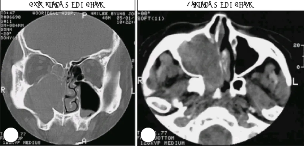 Fig. 4. Preoperative  CT  scan  in  47  yr- yr-old man with right frequent epistaxis. 