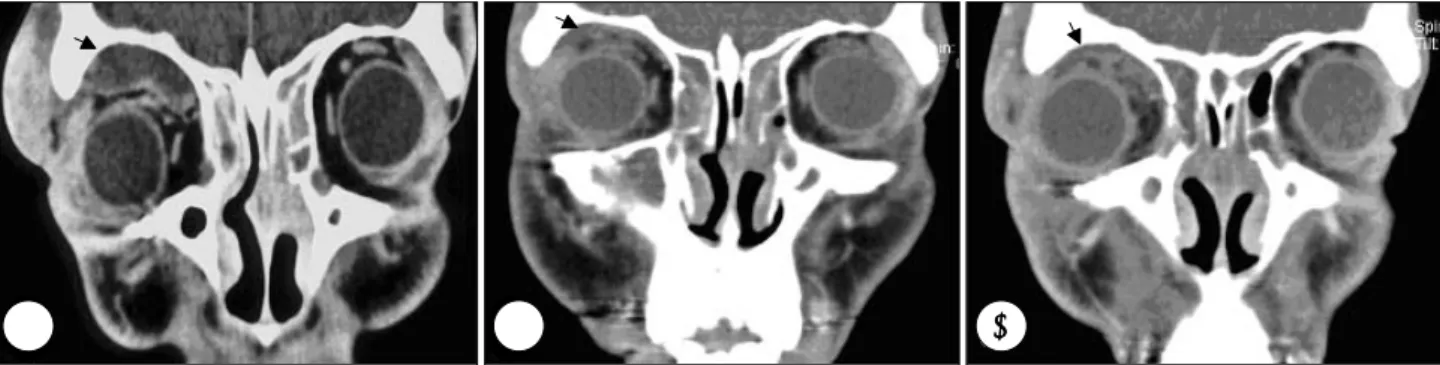 Fig. 1. A coronal view of paranasal sinus computerized tomography from 14 year old male with history of facial trauma