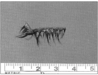 Fig. 2. A false eyelash is being removed from the left orbital tissue herniated into the ethmoid cavity