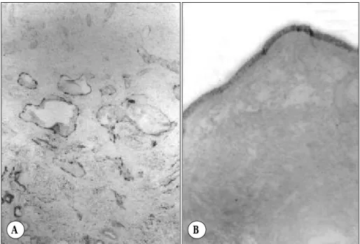 Fig. 2. Representative Western Blots for PIGF and  β-actin (A). A strong band representing the molecular weight of PIGF can be seen  in all inferior turbinate mucosa and nasal polyp studied