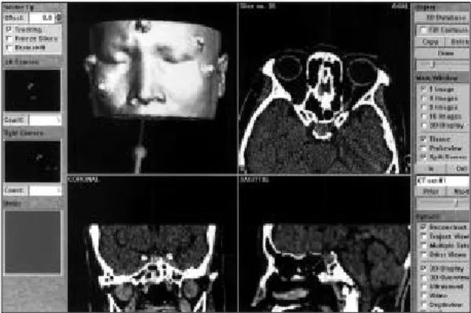 Fig. 3. Probe on the left lateral wall of the sphenoid sinus. 