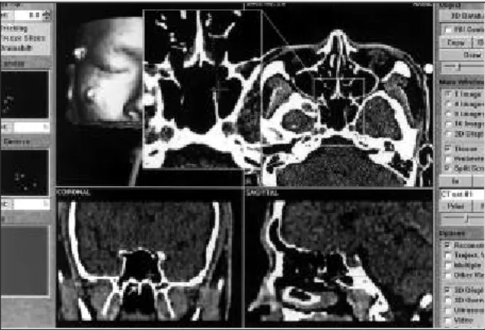Fig. 3. Probe on the left lateral wall of the sphenoid sinus. 