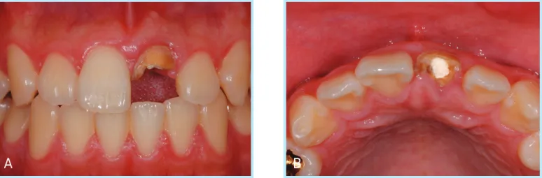 Fig. 2.  Preoperative periapical radiograph.