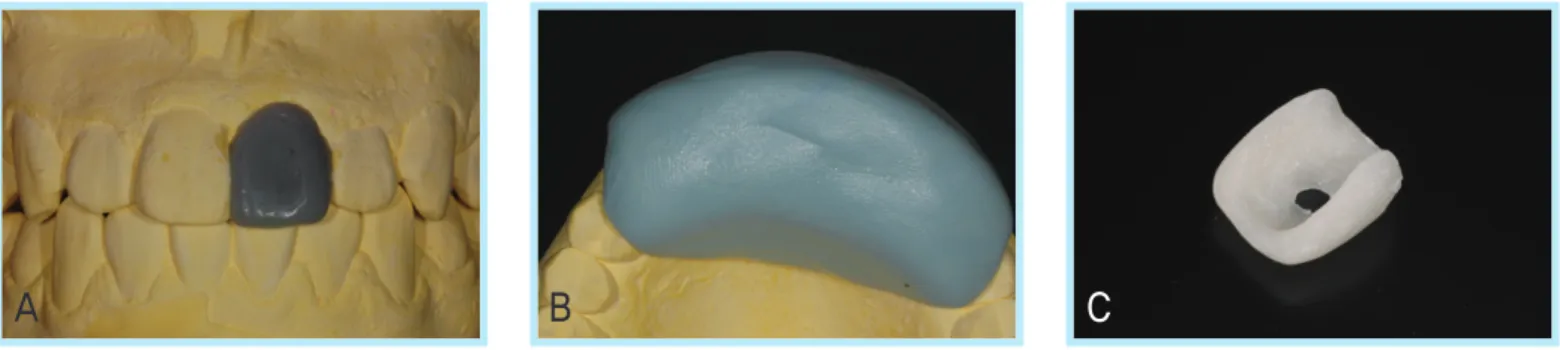 Fig. 4.  Intraoral photographs of immediate implant placement. ((A A)) after flap reflection, ((B B)) occlusal view of the extraction socket, ((C C)) after implant placement.