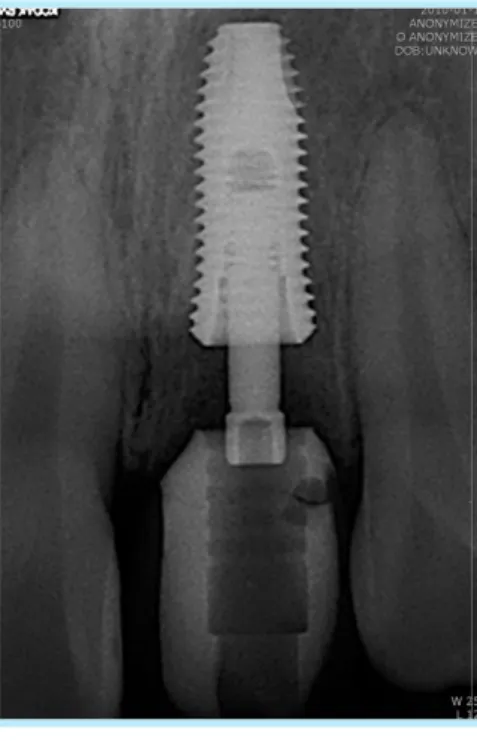 Fig. 7.  Postoperative  periapical radiograph. 