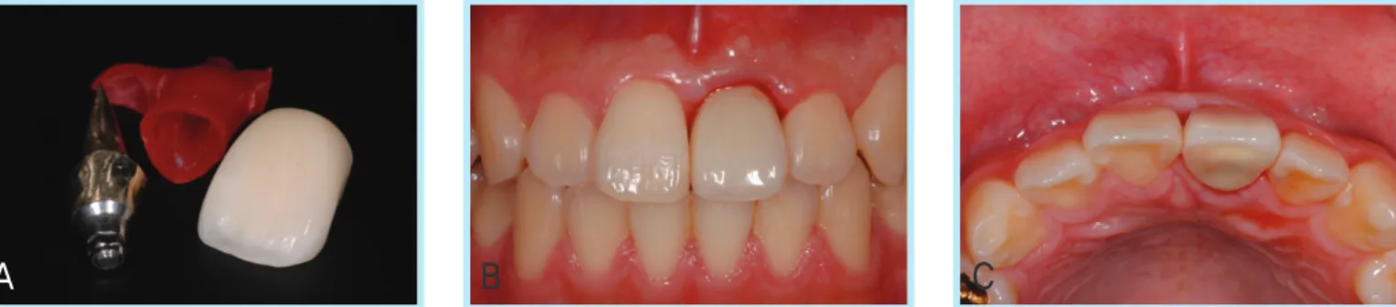 Fig. 10.  Photographs of the final prosthesis placement 16 weeks after implant placement