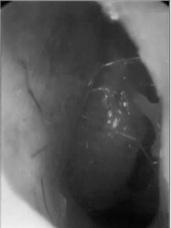 Fig. 3. Coronal section of computerized tomography reveals  the contact points between the hypertrophied middle  tur-binate and the septum bilaterally