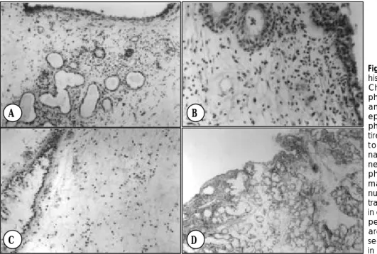 Table 1. Sinus involvement on antrochoanal polyp patients by  operative findings 