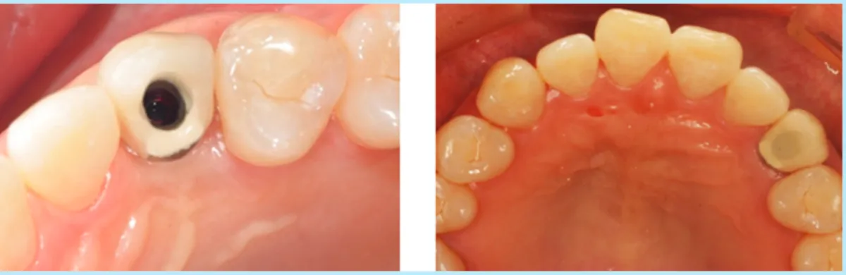 Fig. 16.  Axial loading and offset loading on the implant crown.