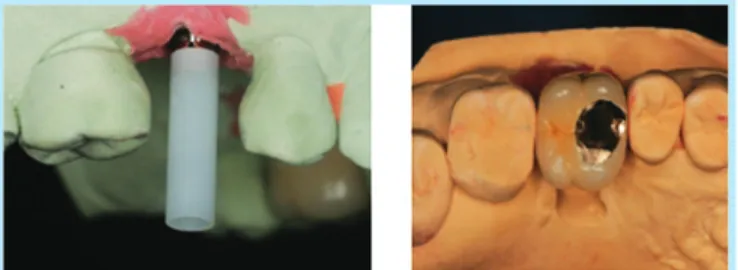 Fig. 2.  Titanium abutment and cement-retained pros- pros-thesis.  