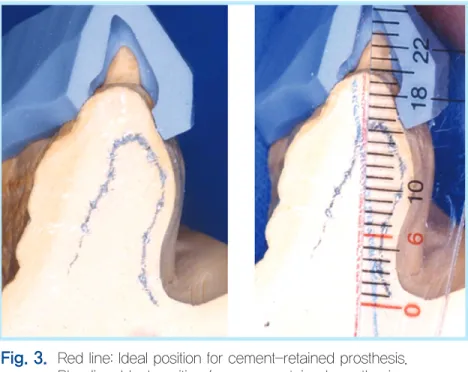 Fig. 3.  Red line: Ideal position for cement-retained prosthesis.