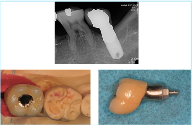 Fig. 5.  Screw-retained prosthesis for deep implant position.