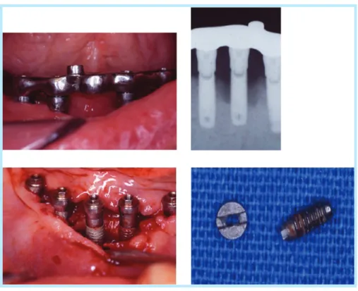 Fig. 7.  Screw fracture and surrounding bone resorption due to failure of passive fit.