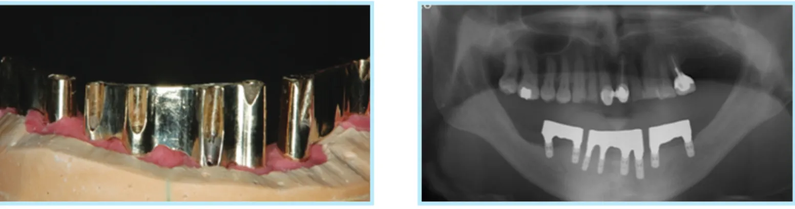 Fig. 9.  Multiple implants are connected using 3-piece sectional casting.