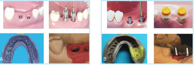 Fig. 12.  One-piece and two-piece abutment for cement-retained prosthesis.
