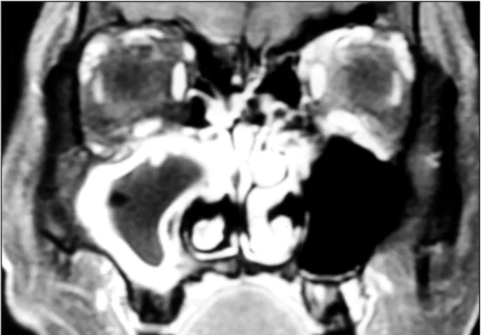 Fig. 6. Nasal polyp with sinusitis. Coronal T1 Gd-enhanced MRI  shows peripheral rim enhancement of the right maxillary sinus.