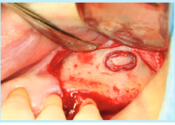 Fig. 16.  Piezo-surgery bur를 사용한 외측창 골 절제술
