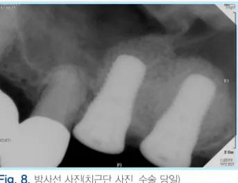 Fig. 8.  방사선 사진(치근단 사진, 수술 당일)