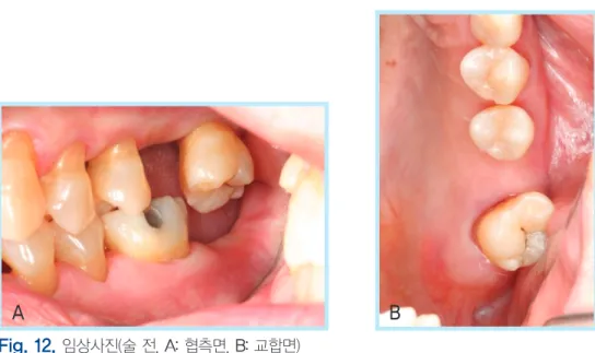 Fig. 12.  임상사진(술 전, A A:: 협측면, B B:: 교합면)