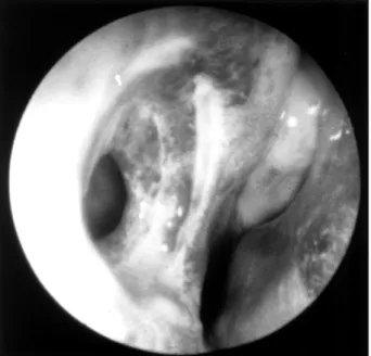 Fig. 1. Nasal endoscopic finding of a button battery foreign body in the left nasal cavity (case1)