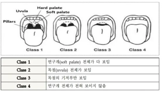 Fig. 1. 기도 평가 방법(Modified Mallampati classification) ([진정약물 투여 후 환자 감시 미흡 관련] 주의경보 참고자료, 2018 의료기관평가인증원).