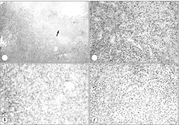 Table 3. Classification of lymphoma by immunohistochemical staining 