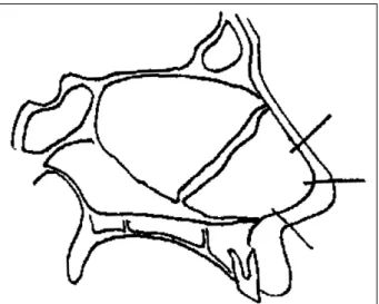 Fig. 3. Reinsertion of the cartilaginous plate and fixation. 