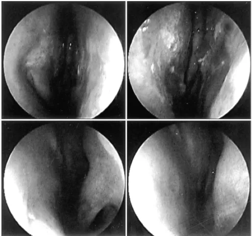Fig. 6. Postoperative view of nasal cavity  with straightened nasal septum. 