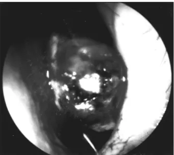 Fig. 2. Preoperative PNS axial CT finding of case 1. Homoge- Homoge-neous mass with smooth margin is attached at the left side of nasal septum