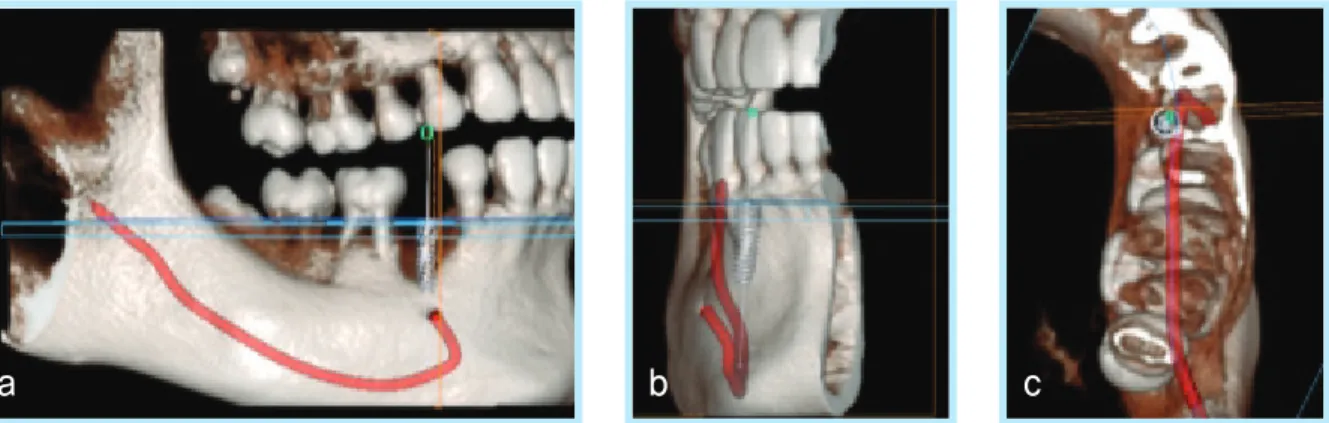 Fig. 4.   골질 및 식립 위치확인.