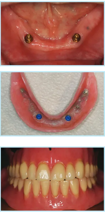 Fig. 5.  Upper and lower denture.