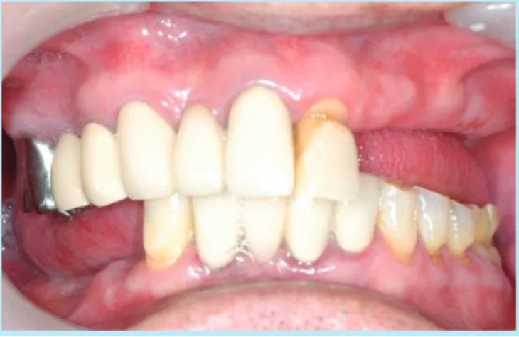 Fig. 2.  Panoramic view-Before treatment. 