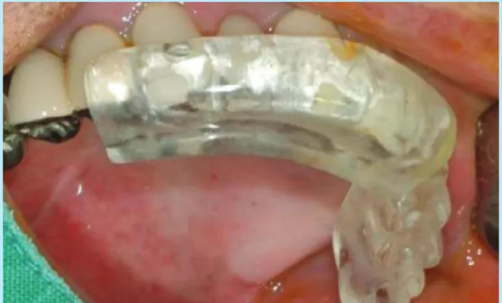 Fig. 6.  3mm twist drill insertion at the 2 nd anterior tooth portion. 