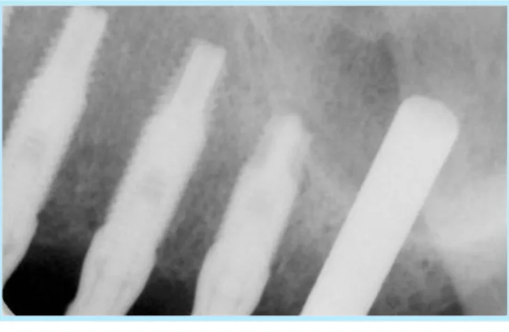 Fig. 11.  X-ray view : Upper left 1st molar tooth portion after insertion of the osteotome.