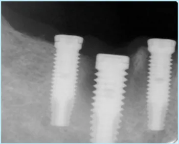 Fig. 18.  3 implants were inserted  : Lower 1 st premolar(D;3.75mm, L;13mm),  2 nd premolar(D;5mm, L;13mm), 