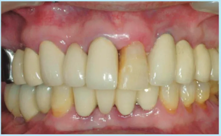 Fig. 21.  Occlusal view-after lower right 3unit PFG bridge setting.