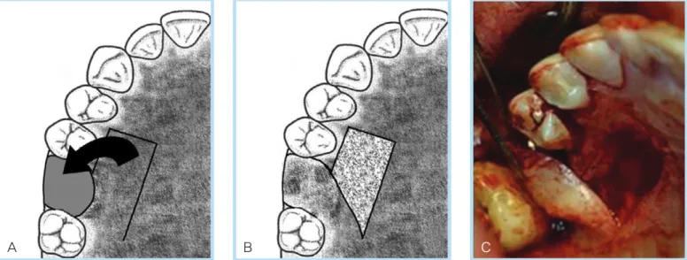 Fig. 1.  Palatal rotation flap. (A) Diagram. Flap design of palatal rotation flap. (B) Diagram