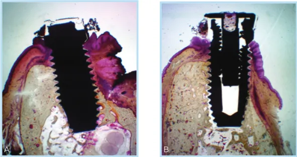 Figure 10.  Application of bone graft material &amp; membrane coverage over dehiscence defect (See the bone housing around dehiscence defect)