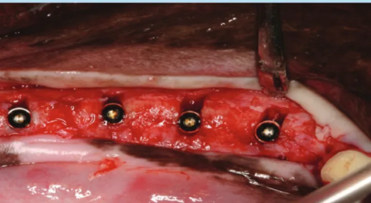 Figure 3.  Clinical photograph of gap defect modelTable 4. Protocol of 3-wall intrabony defect model
