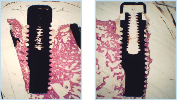 Figure 4.  Comparison  between  the  defect  with  turned  surface  implant(A)  and  the defect with rough surface implant(B)
