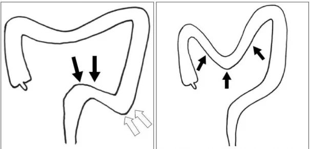 Figure 1. Hand pressure to prevent looping  of  elevate  the  sigmoid  colon(black  arrow)  and  to  make  the  make  it  easy   sigmoid-descending  junction  obtuse(white  arrow)