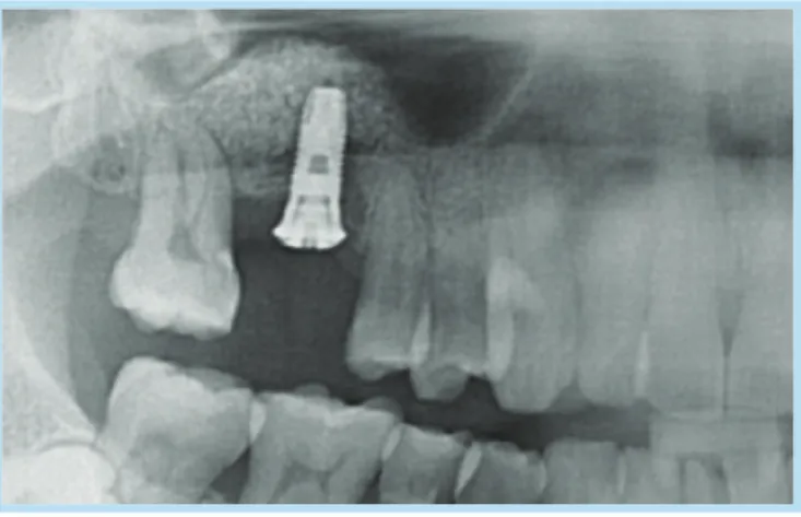 Fig. 3.  After implant placement (2006.05.29)