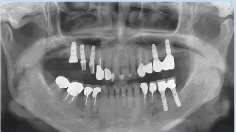 Fig. 7.  After implant placement