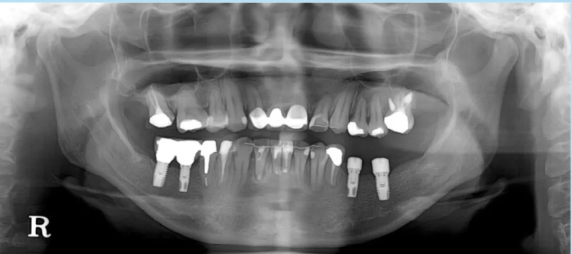 Fig. 8.  Re-entry for membrane removal and healing abutment connection.