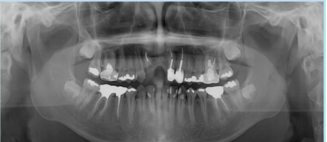 Fig. 14.  Flap elevation and #12 extraction.