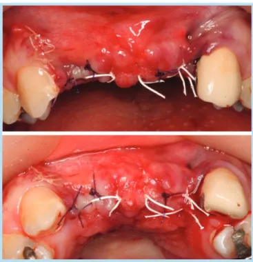 Fig. 17.  Suture after operation.