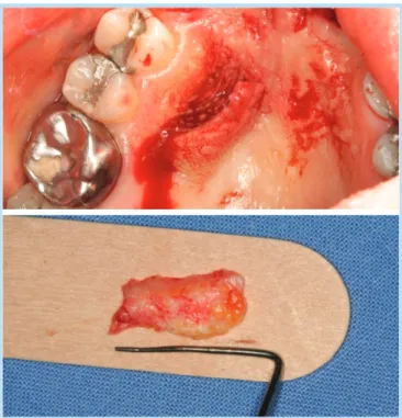 Fig. 20.  Bone-like appearance at the operation site.